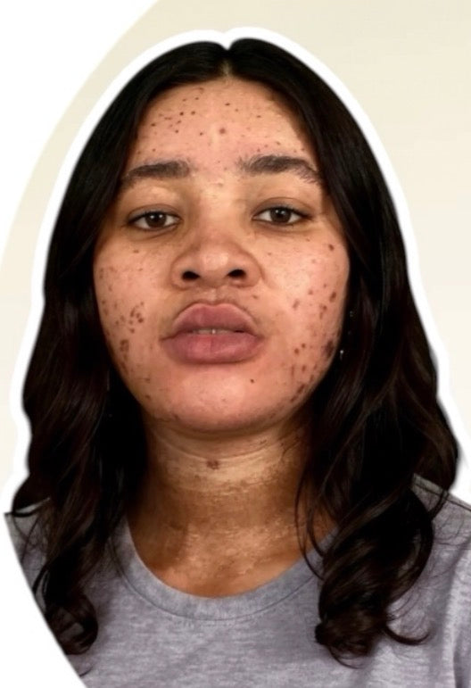 Before — melanin-rich skin with dark spots and uneven tone on cheeks and jawline