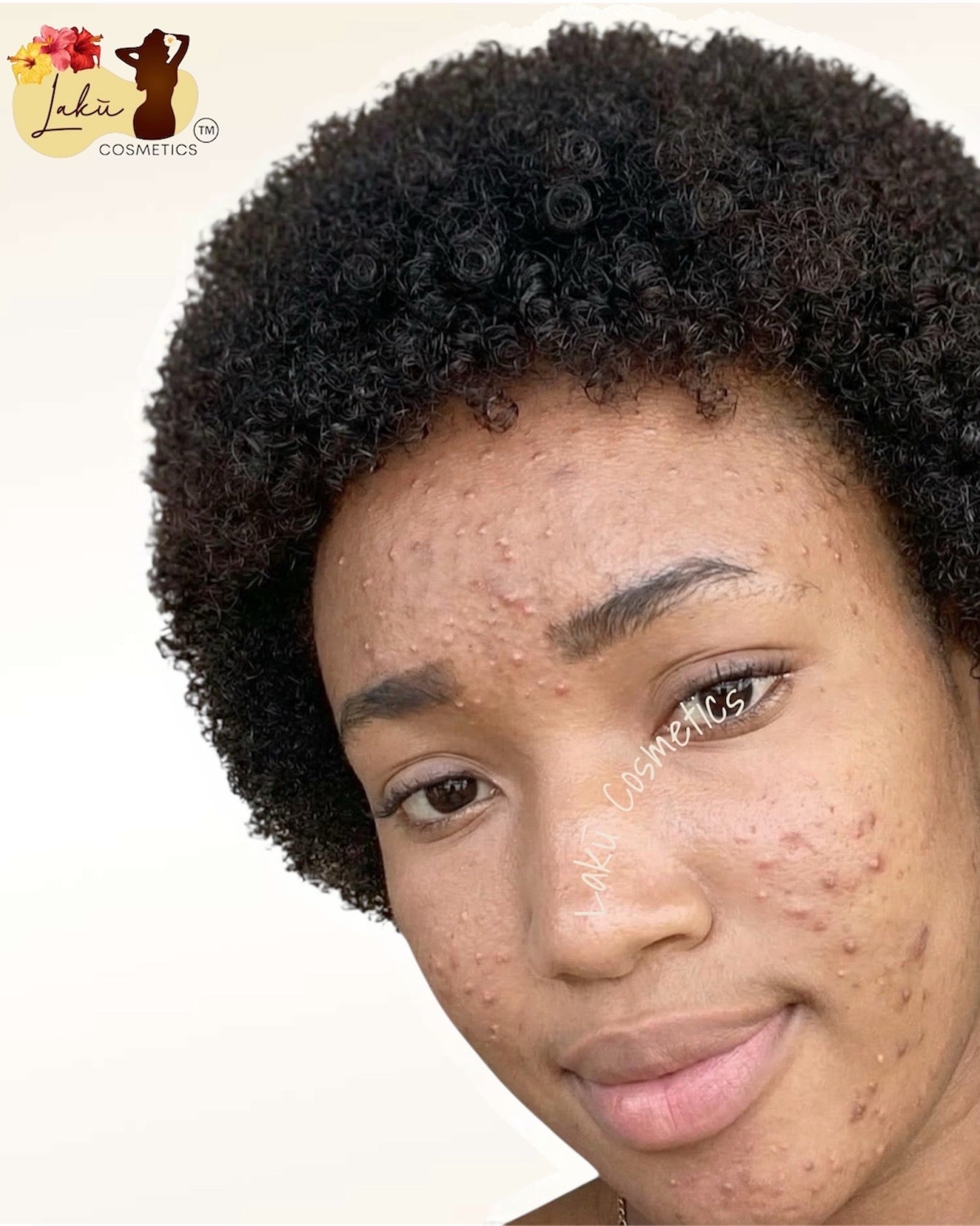 Real Lakū customer with melanin-rich skin showing active acne and post-inflammatory hyperpigmentation across forehead and cheeks — starting state before the Lakū fade routine